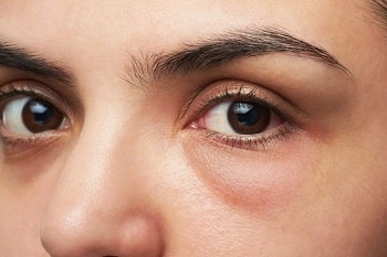 How to Combat Puffy Eyes: Tips for Bright, Refreshed Eyes