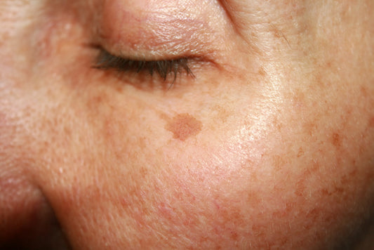 Spots on Your Skin? Sunspots on Your Face are the Worst! Niacinamide is Your Holy Grail!
